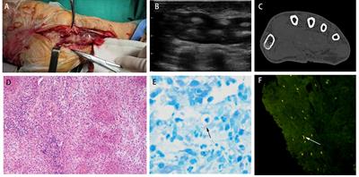 Rapid diagnosis of Mycobacterium marinum infection using targeted nanopore sequencing: a case report